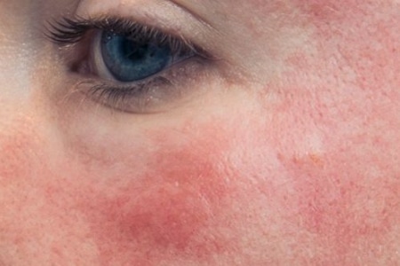 Example of Rosacea