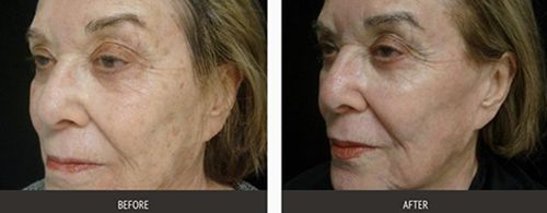eminence-organics-hyperpigmentation-dermatologist-laser-treatment