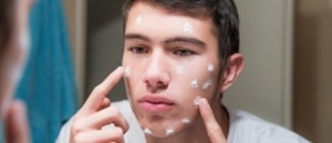Acne Skincare Featured Image