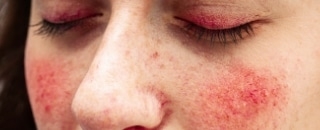 Rosacea Skincare Routine - featured image