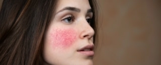 Rosacea Skincare featured image