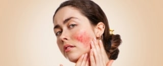 Rosacea skincare featured image
