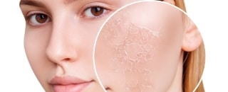 dry-skin-featured-image